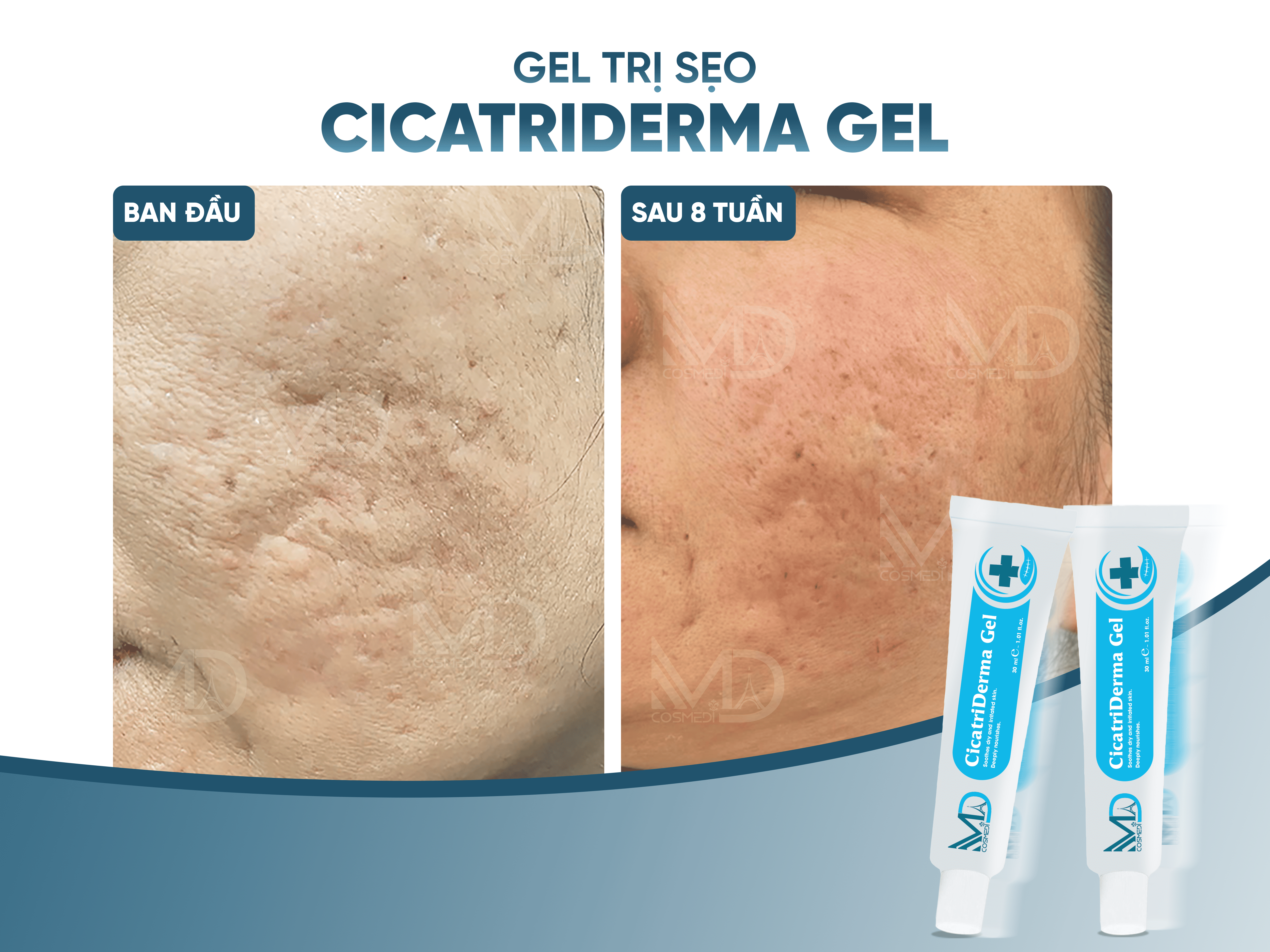 Cicatriderma Gel làm mờ vết thâm do sẹo
