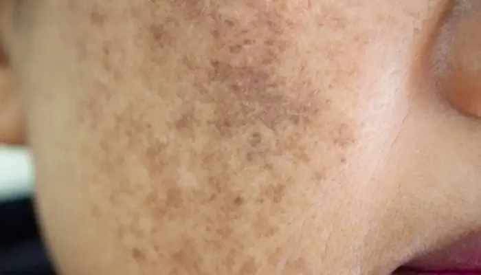 Phương pháp điều trị nám da đến từ MD COSMEDI