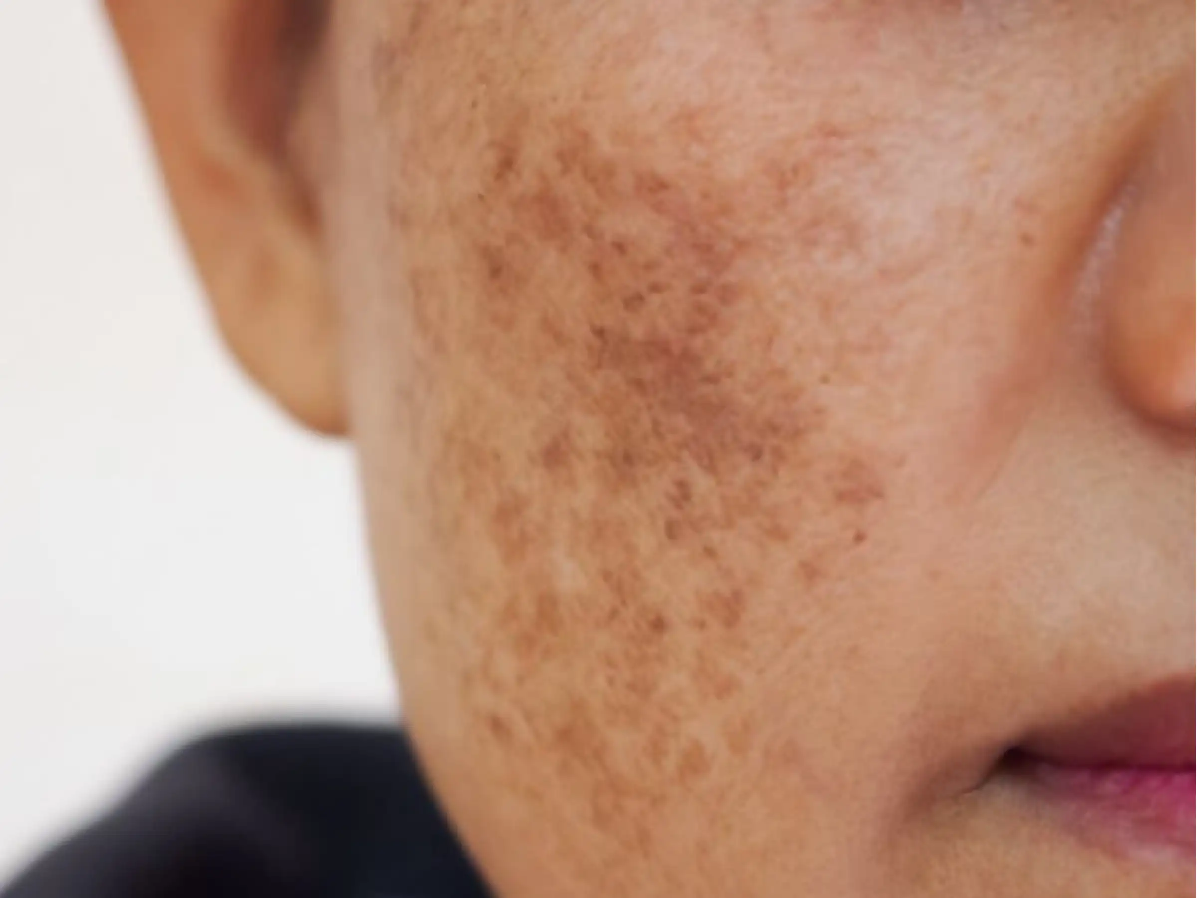 cach-cham-soc-da-mat-bi-nam-cuc-chuan