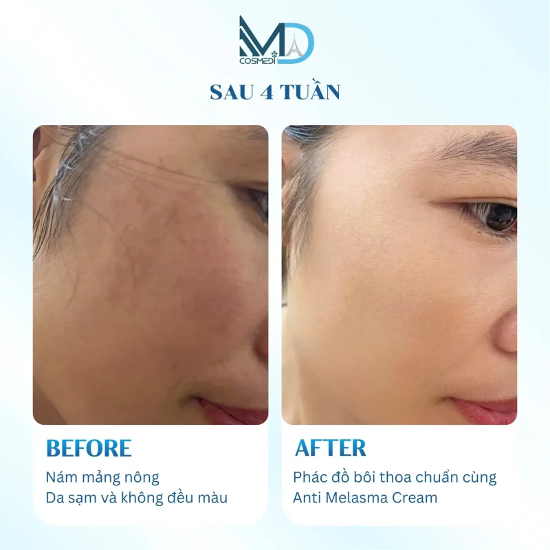 cysteamine-hoat-chat-trong-dieu-tri-sac-to-da