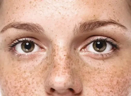 Co che hinh thanh nam da va cach dieu tri hieu qua